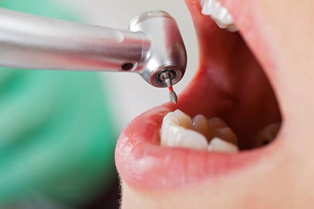 Best Emergency Wisdom Tooth Extraction in Rafter J Ranch, WY